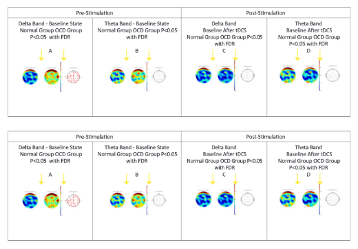 normal-brain-activity-obsessive-compulsive-patients-dlpfc-stimulation.png
